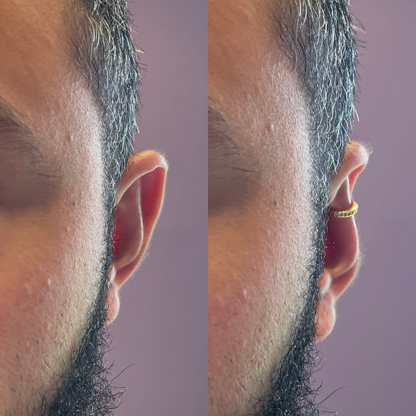 EarSculpt™ - Oorcorrectie oorbel